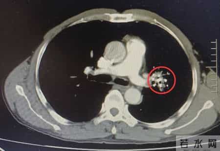 46岁男子戒烟半年后，冠心病离世？医生叮嘱：戒烟但要注意7件事
