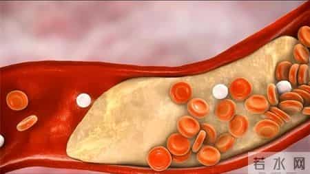 严重可致命！警惕：服用瑞舒伐他汀最怕犯这7个错误，早知早获益