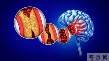 体检报告里这一项异常，竟是脑梗信号？9成人不重视，后悔太晚！