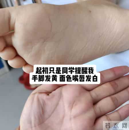 淄博花季女孩丁心萍去世，仅18岁，尖子班的学生，因手脚发黄确诊