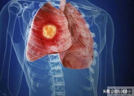 查出肺癌后，他后悔直言：肺癌早期不是胸痛，而是身上5种异常！