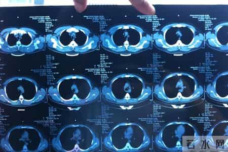 人不会无故得上脑出血？研究发现：得脑出血，背后有5点原因