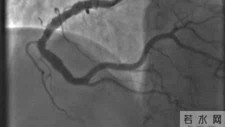 医生提醒：做好3个检查，冠心病一辈子不复发，不要走弯路