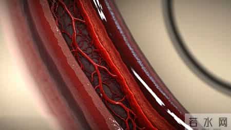 超1.2亿国人查出颈动脉斑块！医生提醒：坚持3点或有望逆转斑块