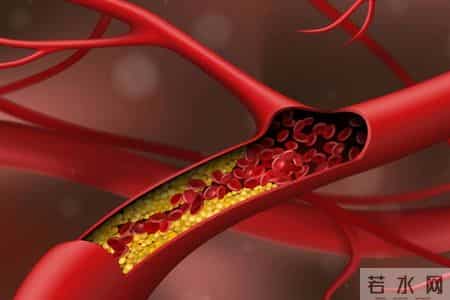 55岁男子冠脉狭窄85%，2年后却完全消失，他的3个方法，值得借鉴
