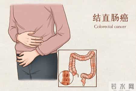 为啥很多人不愿意做肠镜？美国研究：做一次肠镜，或保十年安全