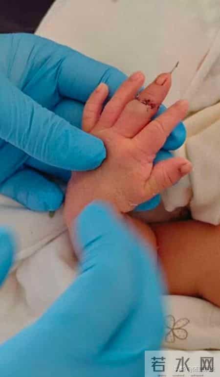 江苏盱眙新生儿指尖被剪，10万赔偿太少了！孩子乱动的借口太牵强