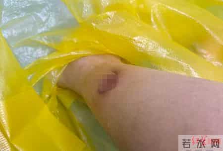 女子睡觉用暖宝宝暖脚被烫伤，创口感染现“深坑”！医生：冬季低温烫伤高发，取暖莫大意