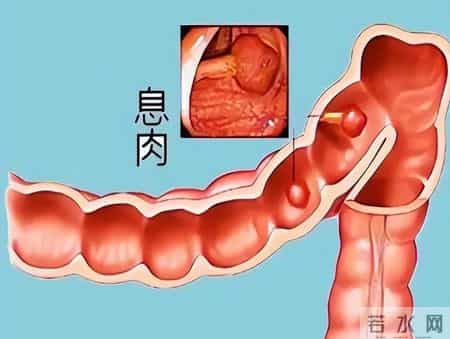 为什么很多人不愿做肠镜？院士：做一次肠镜，或能保你6年没问题