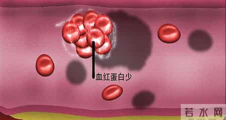 什么样的糖化血红蛋白最危险？专家：这5种异常，你了解吗