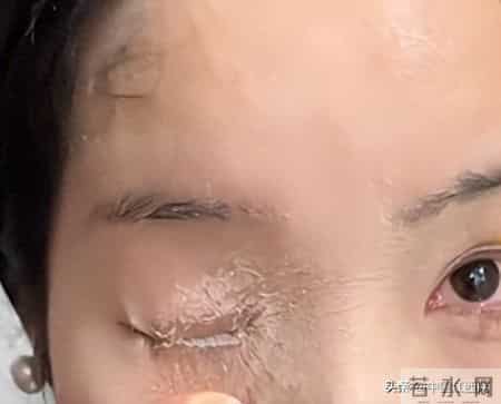 贵州一女子用502胶水贴指甲片，不慎打翻，眼睛、鼻孔都粘住了，当事人：非常痛苦