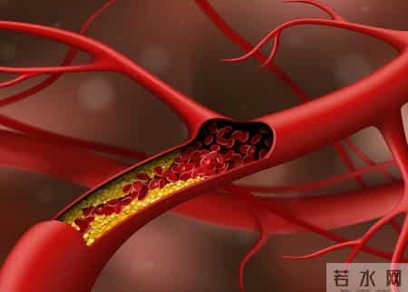 脑血栓离世的人数日益增多！医生反复强调：少吃萝卜，多吃这几物