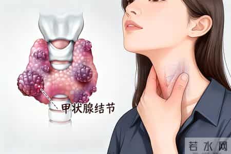 多名院士提醒：查出甲状腺结节多年没恶变，饮食中牢记这6个原则