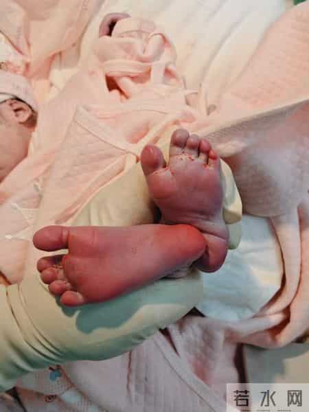 发生率不到万分之一 产科专家精准判断助罕见“单绒单羊”双胎分娩