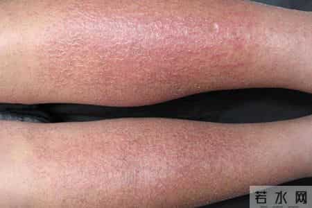 湿疹拖太久可能暗藏隐患，医生提醒：皮肤若出现这5种异常要警惕