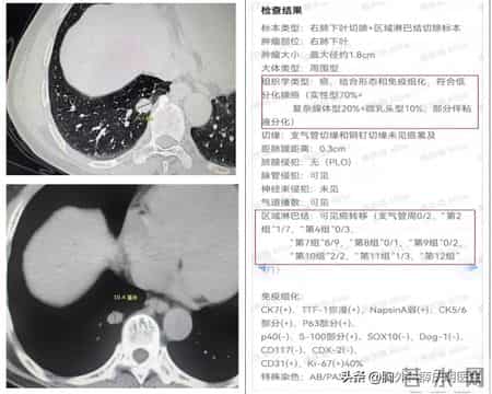 都是2cm肺结节，为何一个轻松治愈，一个已多处转移？