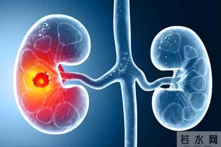 医生提醒：肾衰竭早期不是腰痛，而是身体出现5种异常，一定留意