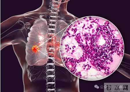 查出肺结节别乱吃！3种常见“养肺散结宝”，消掉双肺多发结节