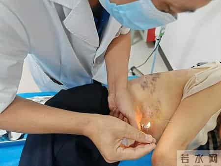 带状疱疹都是咋来的医生调查发现-患带状疱疹的人，有这8大共性