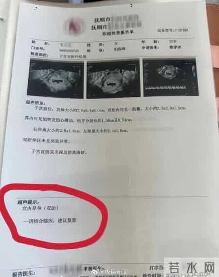 1300万分之一！抚顺孕妈怀同卵四胞胎，第四胎无心靠三胎供血