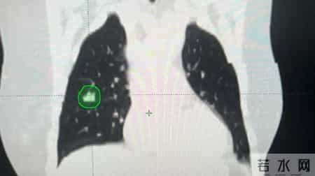 精准攻克！大医二院成功开展首例体部立体定向放射治疗（SBRT）