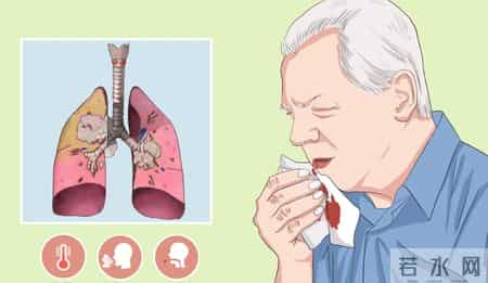 多名医生忠告：肺癌高危人群做完低剂量 CT，务必关注 4 项核心征象