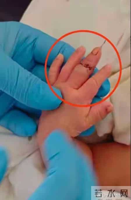 太离谱了！手指被当脐带剪断，新生儿脸涨红哭得撕心裂肺，好心疼