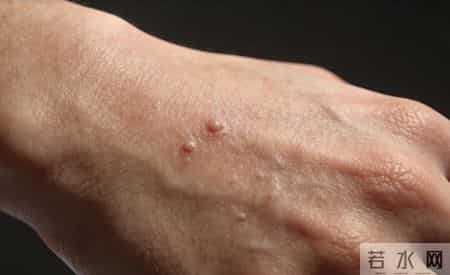 为何 HPV 相关疣类总反复？多数人忽略的1个关键，比激光冷冻更管用