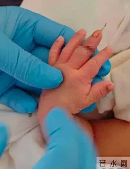 剪脐带，竟剪断新生儿手指？助产士称“孩子的手突然乱动”