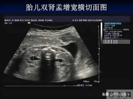 超声提示“胎儿肾盂集合系分离”，就一定是男宝吗？