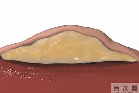 慢性咽炎不治会变严重吗？这些症状要重视，早诊断早治疗