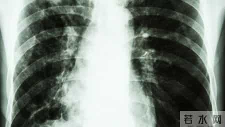 多名医生忠告：慢阻肺患者做过肺功能检测，务必重点4项核心结果