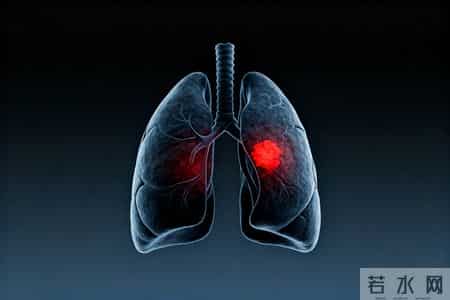 体检报告中这个指标升高，或是肺癌早期信号，很多人却没当回事
