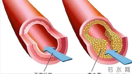 间隔一天吃他汀，降脂效果更好？医生提议：服用他汀，谨记这5点