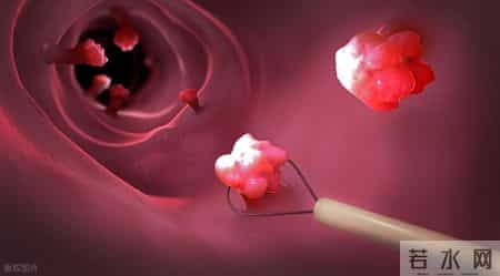 自2026年起，体检发现肠息肉的患者，千万重视做好这5项准备