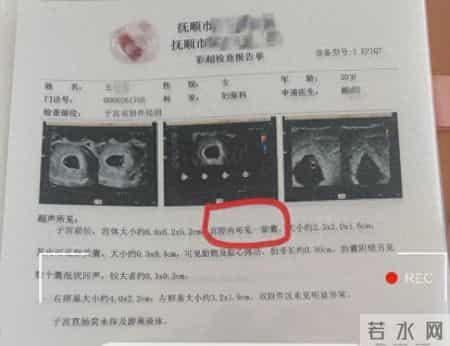 概率仅1300万分之一！辽宁孕妇产检一胎变同卵四胎：尚无异常，只是4个月胖20斤