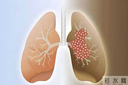 肺癌真凶找到了！医生提醒：不想被肺癌“带走”！3件事忽视不得
