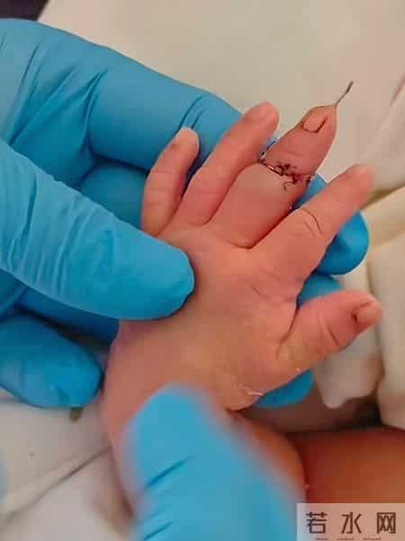 心疼到哭！新生儿剪脐带被剪断手指，医院的回应我听不下去