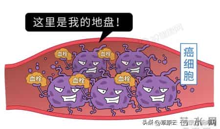 长期咳嗽，外加双腿出现这 3 个症状，可能是肺部已经癌变！千万别不重视