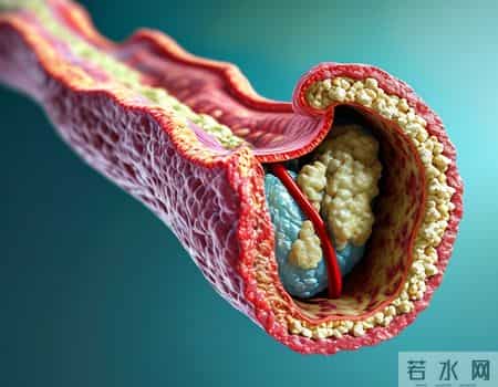 美国脂质学会【最新血脂标准】：所有人的“低密度”都应＜2.6！
