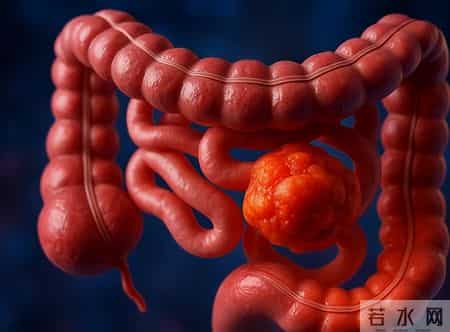 59岁男子大便次数增多没在意，三个月后因为癌王去世，很可惜