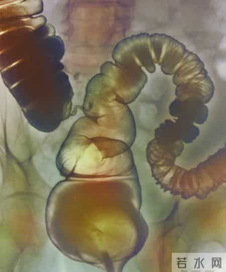 为啥很多人不愿意做肠镜？美国研究：做一次肠镜，或保十年安全？