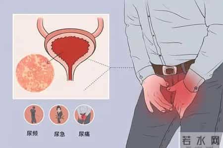 多名医生提醒：只要做过前列腺B超，中老年男性务必重视这3指标！