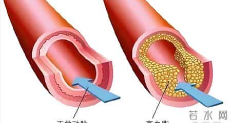 多名医生忠告：高血脂患者做完血脂四项检测，务必牢记 4 关键结果