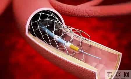 心脏支架一放，人生倒计时就开始了？医生说出实话：这6点要注意