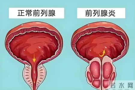 多名医生提醒：只要做过前列腺B超，中老年男性务必重视这3指标！