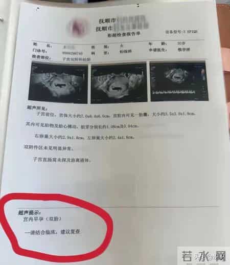 同卵四胞胎，每次产检多一个，她能保下几个