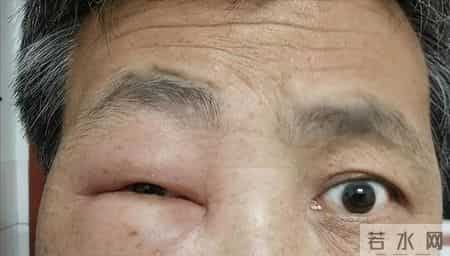 尿毒症早期不是浮肿，而是起床时出现这5个症状，要尽早去检查！