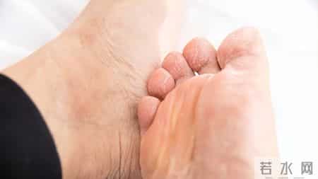 脚气总是反反复复？医生提醒：若发现脚气，日常谨记“3做4不做”