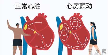 房颤引发卒中 3 预警信号！忠告：出现一个就就医，别错过救治时机